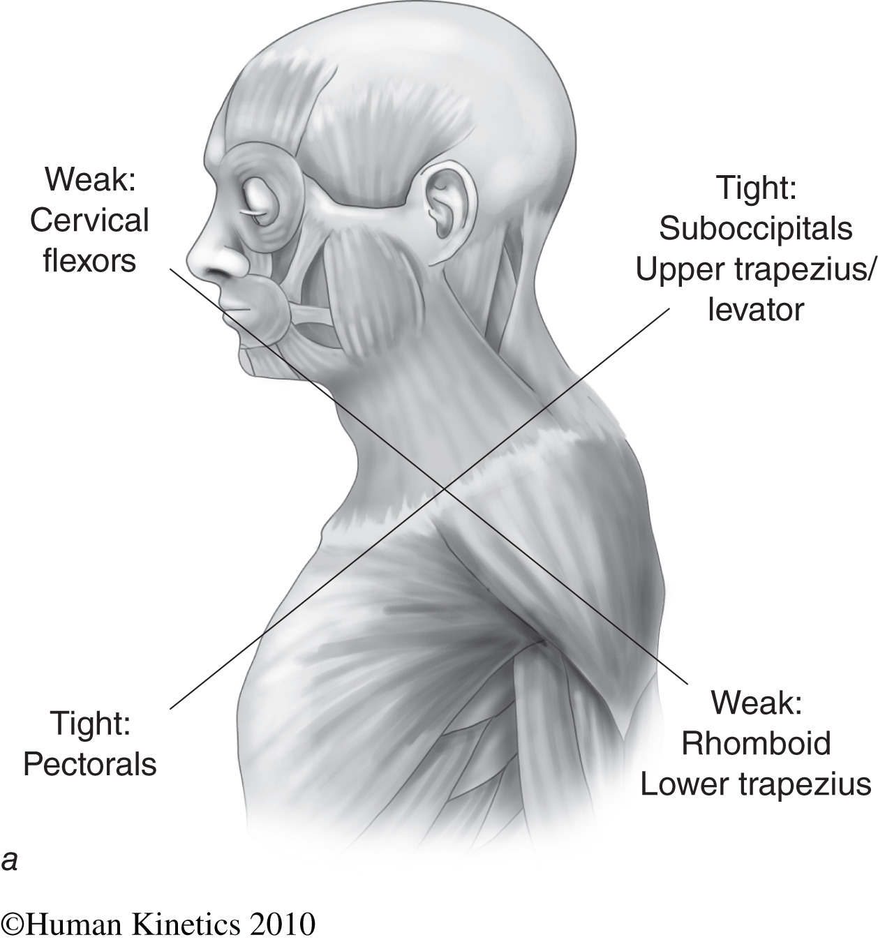 Upper Crossed Syndrome?