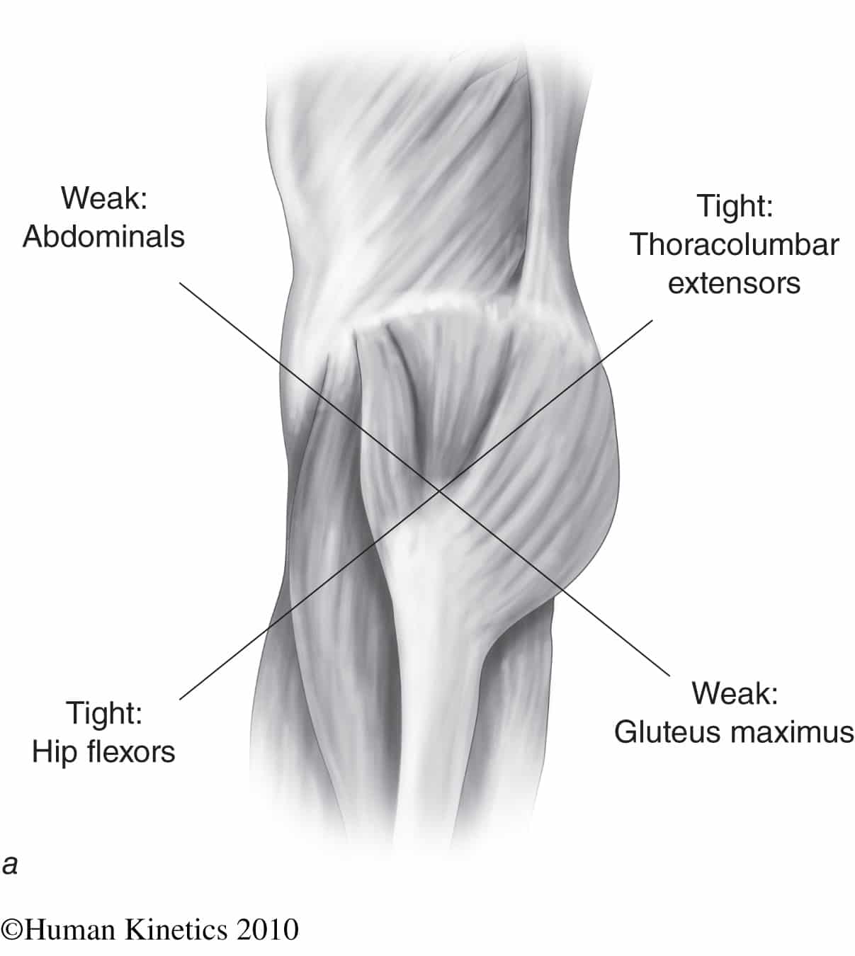 Muscular Imbalance