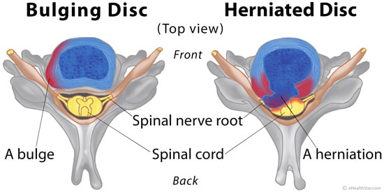 3 Causes of Hamstring Tightness