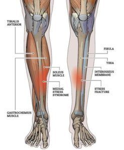 Running Injuries