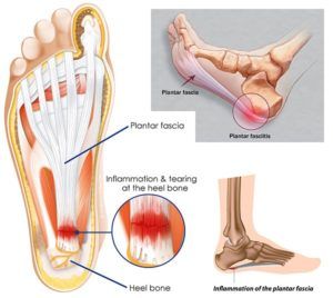 Running Injuries