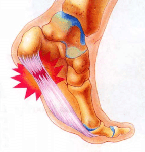 What is Plantar Fasciitis?