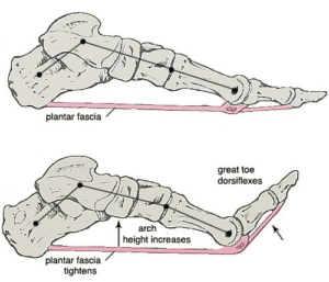 What is Plantar Fasciitis?