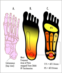 What is Plantar Fasciitis?