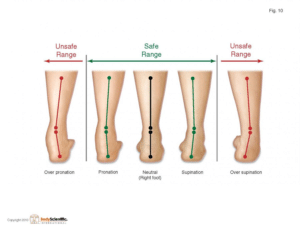 What is Plantar Fasciitis?