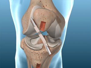 Anterior Cruciate Ligament