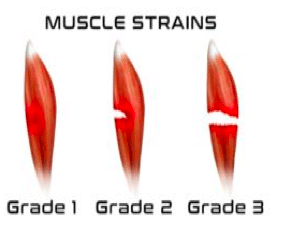 muscle strain