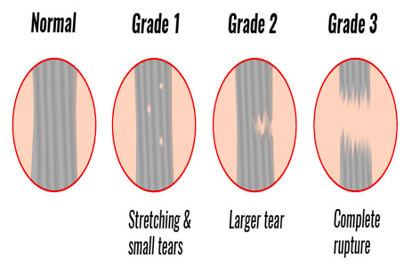 ligament tear