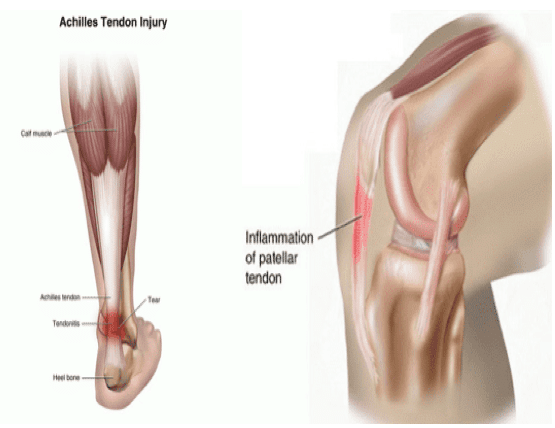 tendon injury