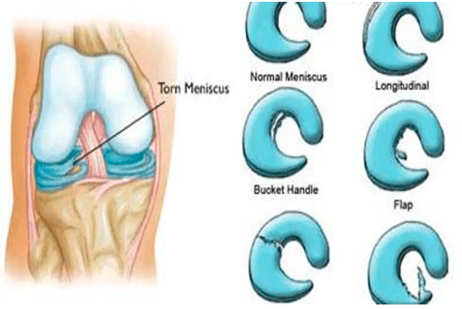 Meniscus tear