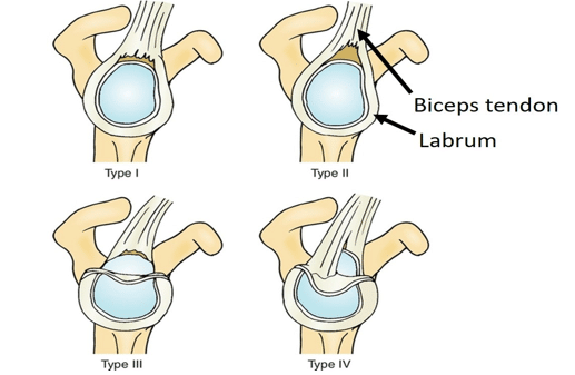 Labrum tear