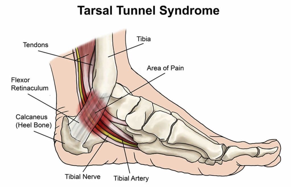 Tarsal Tunnel Syndrome