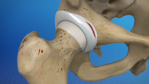 Labral tear symmetry pt miami