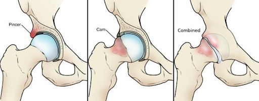 Hip Impingement symmetry pt miami