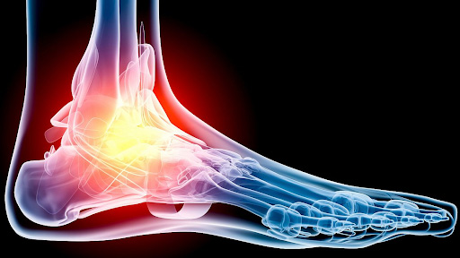 Physical therapy for foot pain symmetry pt miami