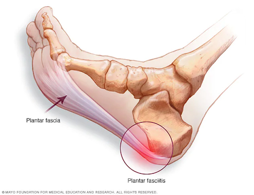 Physical therapy for plantar fasciitis symmetry pt miami