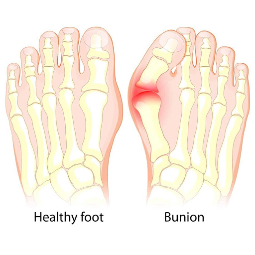 bunions symmetry pt miami