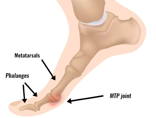 Hallux Rigidus symmetry pt miami