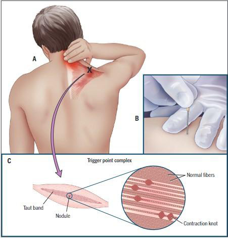 Dry needling symmetry pt miami