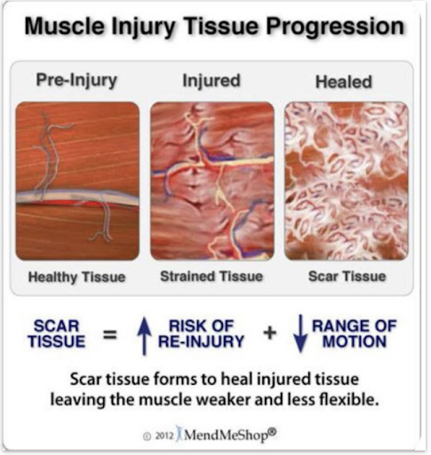 How can I get Fibrosis in my muscles? Symmetry pt miami