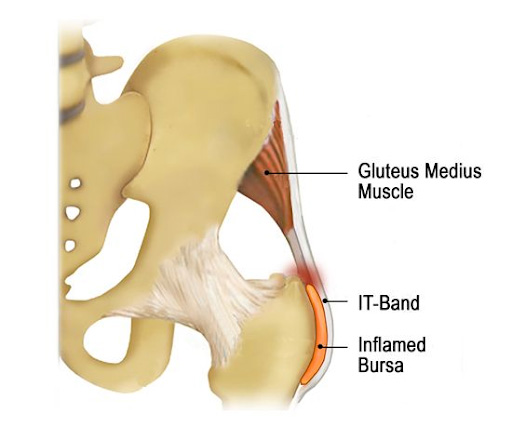 Trochanteric Bursitis and PT treatment