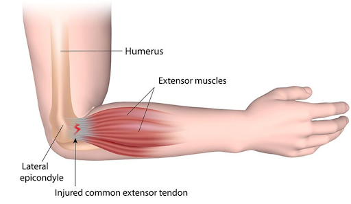 Lateral Epicondylitis 1