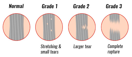 Rotator cuff tear stages