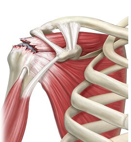 Rotator Cuff Tear Diagram